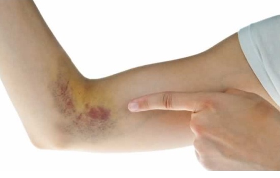 Синяк на руке – обычная вещь или опасная гематома